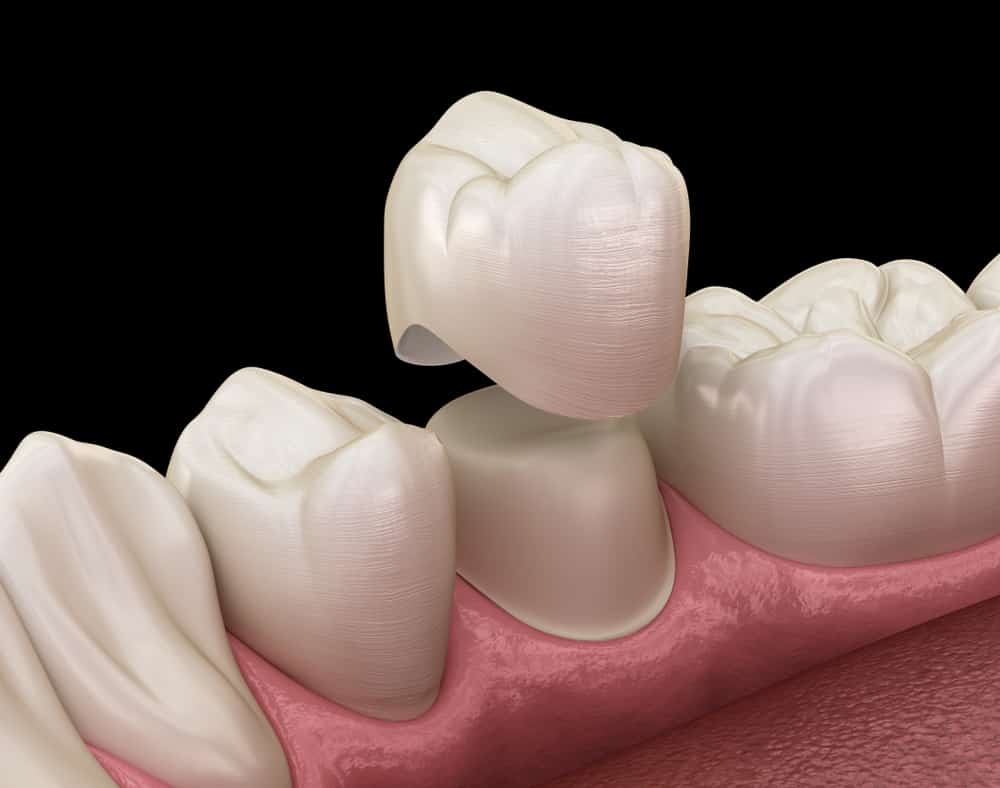 Do You Need To Brush Crowns And Veneers? CEREC dental crown VIP Smiles dentist in Syracuse, Utah