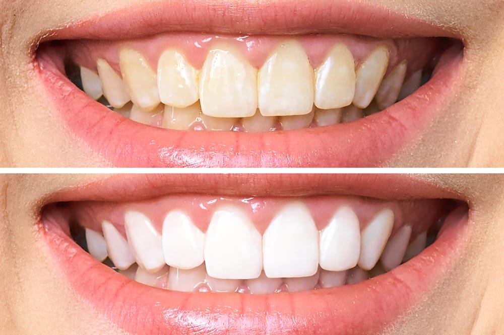 teeth whitening VIP Smiles dentist in syracuse ut