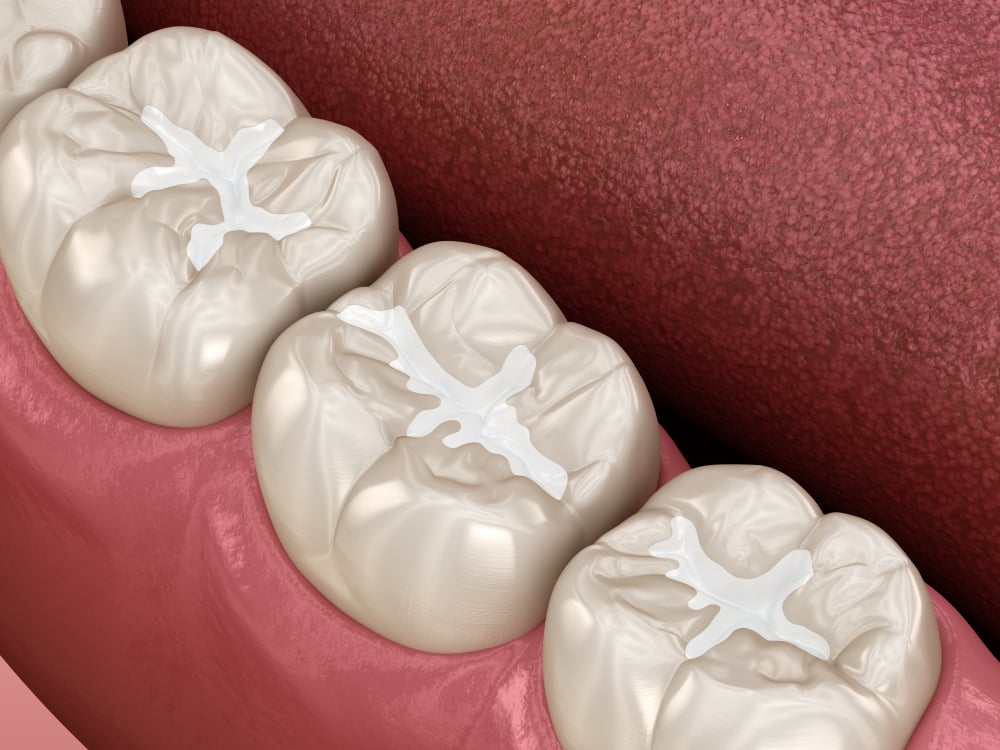 VIP Smiles Family Dentistry Syracuse, UT Dental Sealants