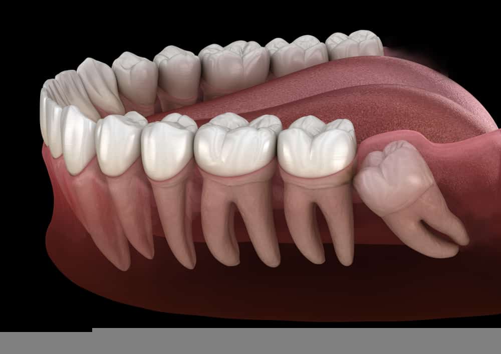 wisdom teeth removal VIP Smiles Family Dentistry Syracuse, UT