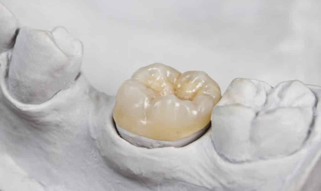 Ceramic Inlays And Onlays ceramic inlays and onlays Syracuse Ut