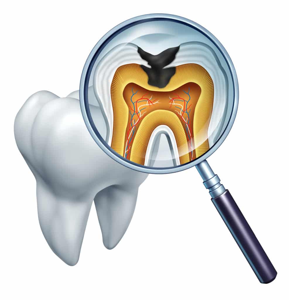 DIAGNOdent laser cavity detection Syracuse UT VIP Smiles Dental