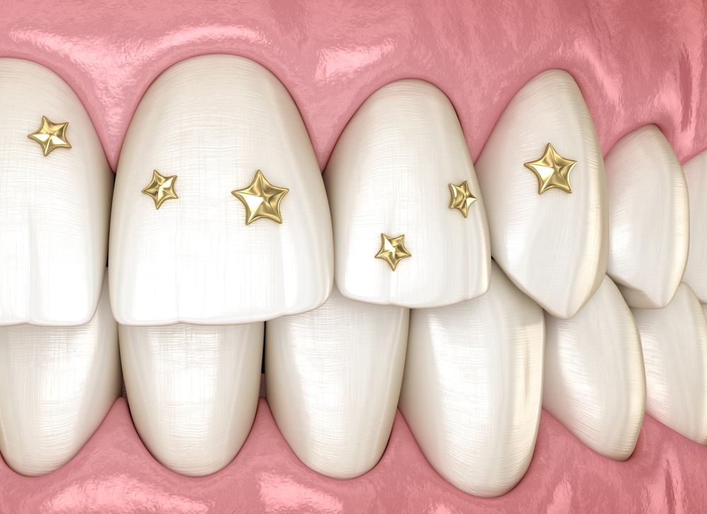 The Dangers of Tooth Gems - Stensland Dental Studio