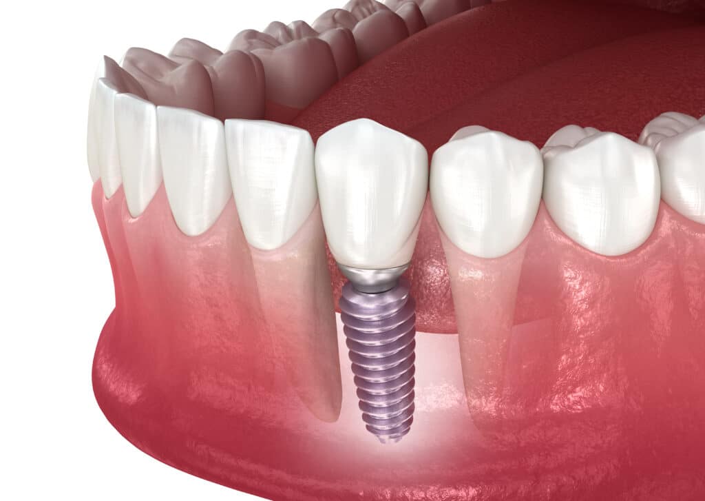 5 Effective Ways to Fix Broken Teeth