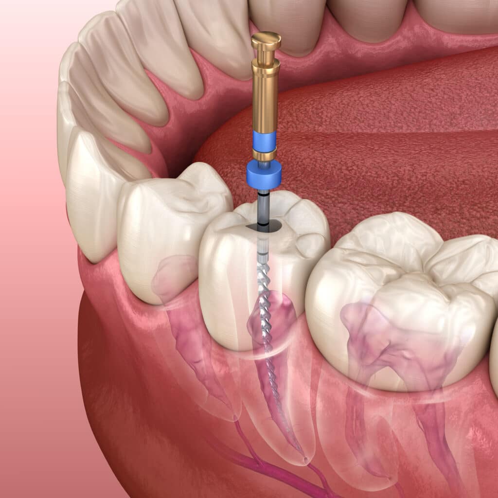 5 Effective Ways to Fix Broken Teeth