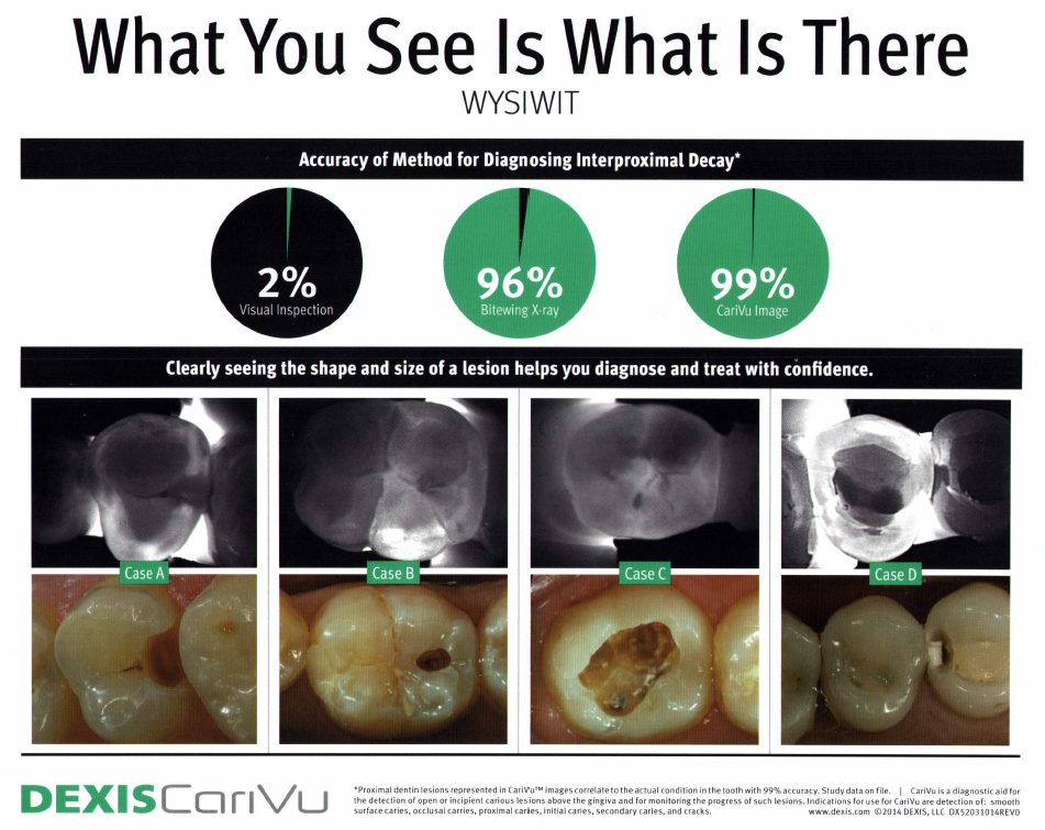 Advanced Cavity Detection: The Key to Effective Dental Care