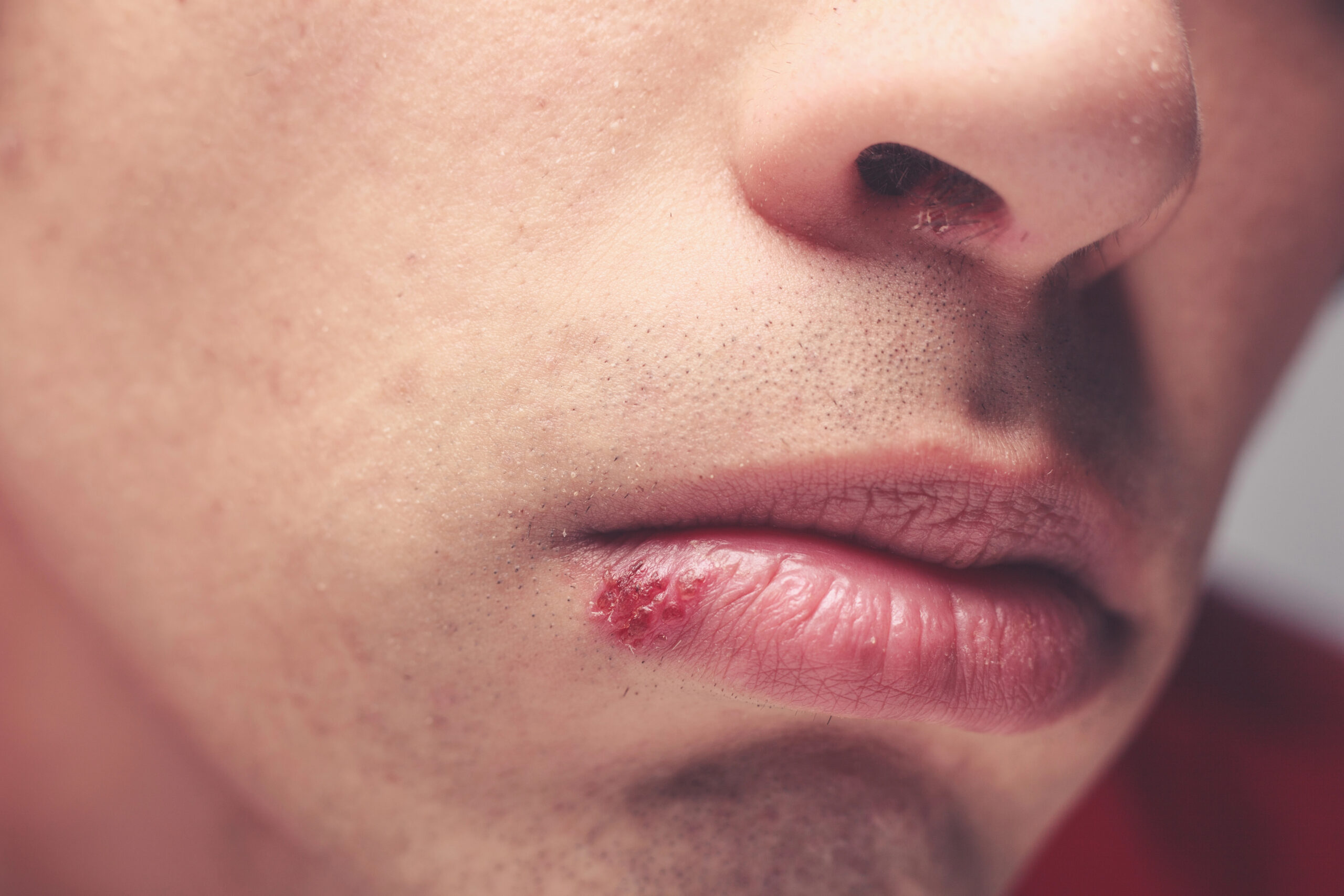 cold sore