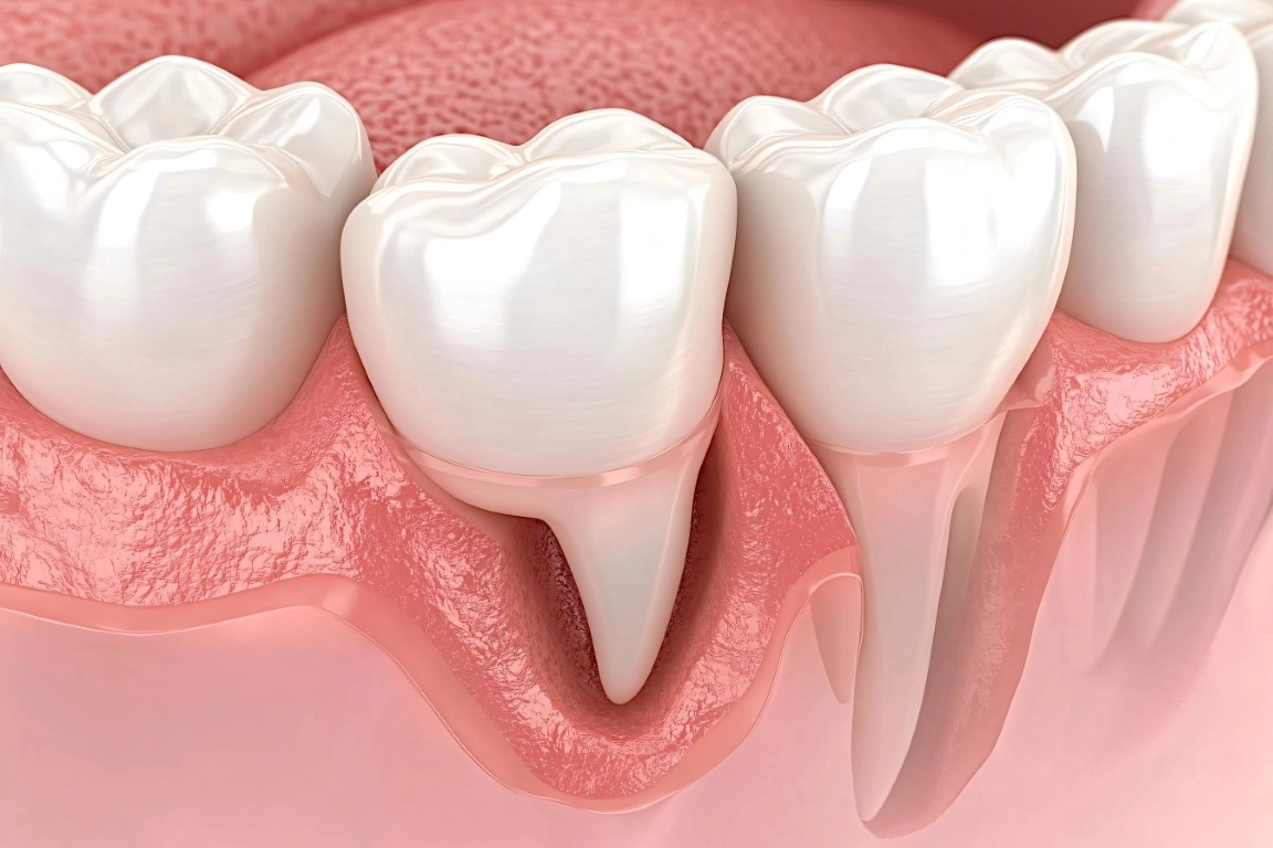 receding gums