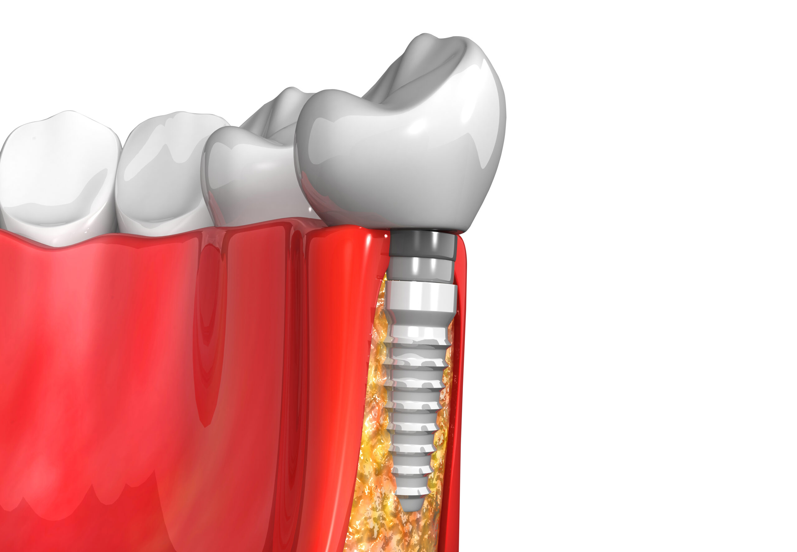 avoid dental implant failure