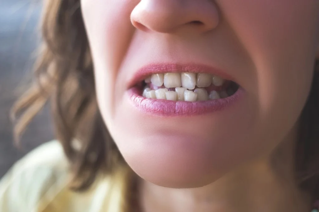 Do You Need Braces To Fix Crooked Teeth? Do You Need Braces to Fix Crooked Teeth
